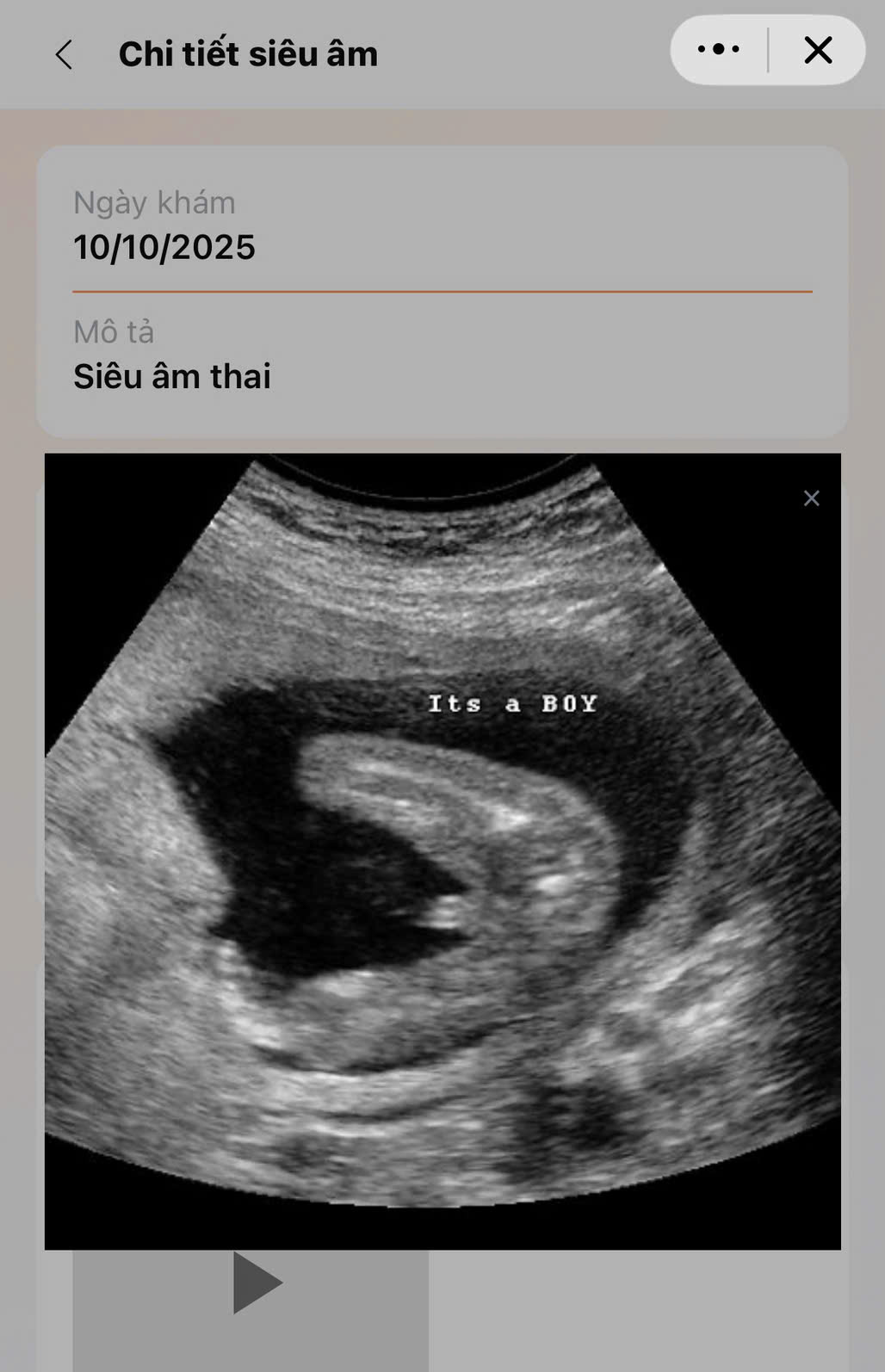 Zalo Mini App - Kết quả siêu âm